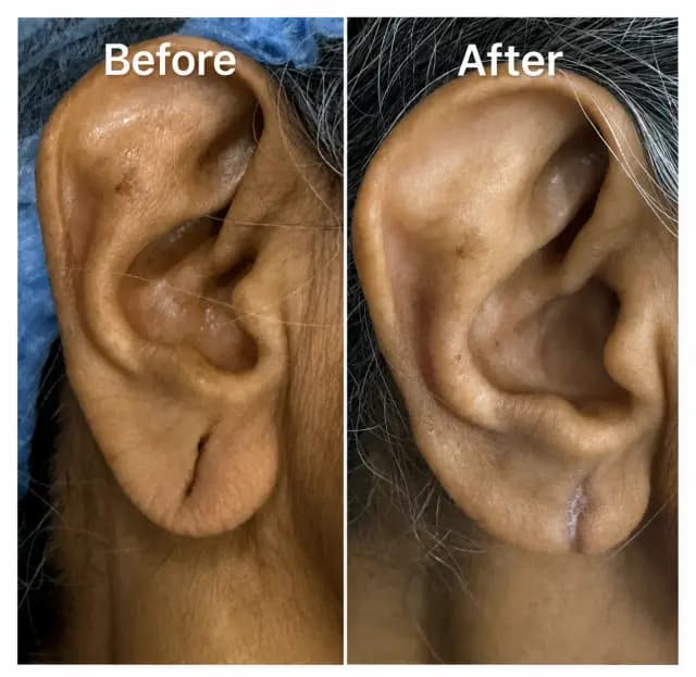 Ear Transformation