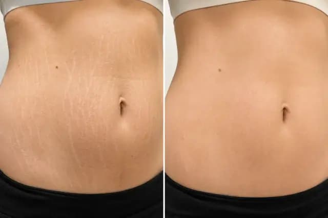 Stretch Mark Removal