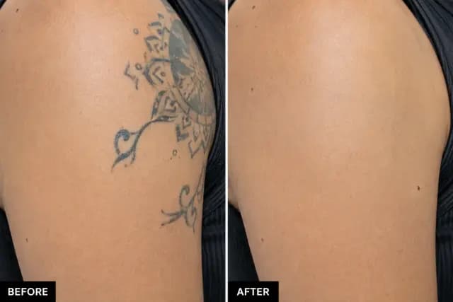 Tattoo Removal