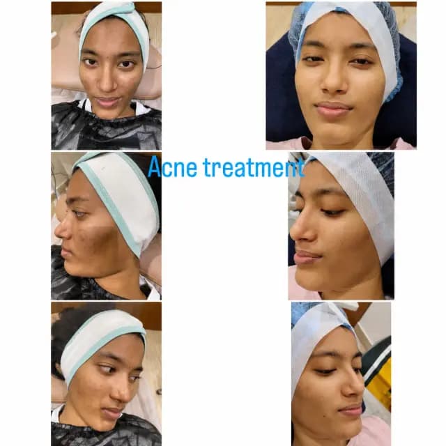 Acne & Scar Treatment