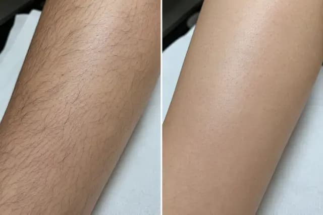 Laser Hair Removal